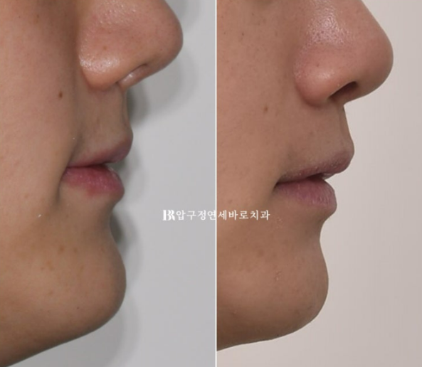 양악수술과 인비절라인의 조합, 왜 시너지가 좋을까? 관련 이미지 11