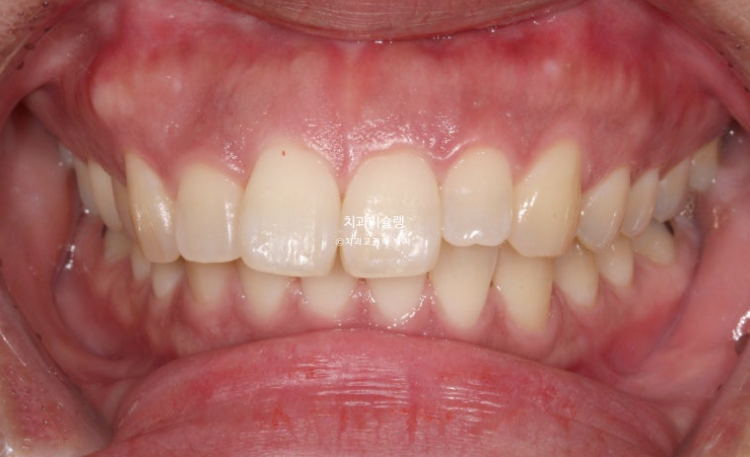 Extraction Orthodontics with Clippy-C for Protruding Mouth, Gum Smile, Gummy Smile Correction, and Treatment for a Recessed Chin image 2