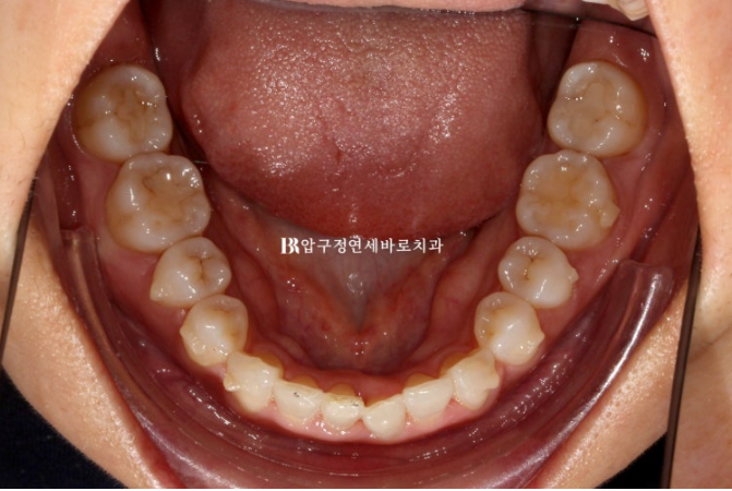 50대 치아교정 후기|잇몸퇴축과 덧니를 개선한 인비절라인 관련 이미지 6