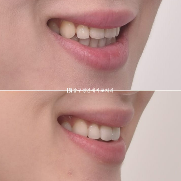 How to Create a Beautiful Smile Line? | A Real Case of Changing a Smile with No-Prep Laminates image 14