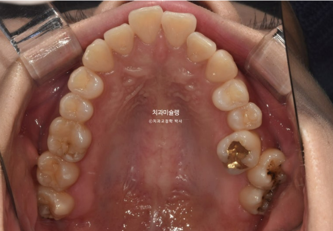 비발치 돌출입 인비절라인 교정 가위교합 중심선 맞추기 관련 이미지 5
