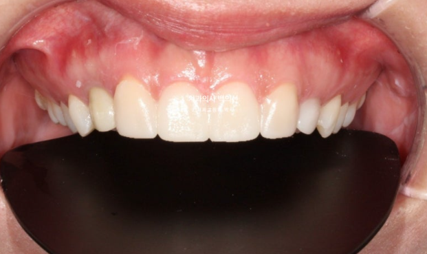 앞니 선천적 결손 벌어짐 잔존 유치 무삭제 라미네이트 관련 이미지 7