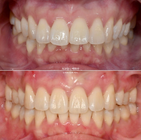 돌출입 교정 인비절라인 발치 교정 후기 관련 이미지 16