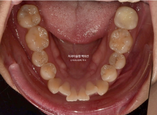 인비절라인 돌출입 발치교정 임플란트 없이 사랑니 대체 관련 이미지 4