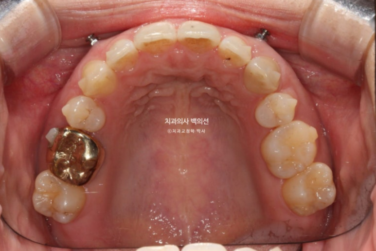 인비절라인 라이트 재교정 발치공간 벌어짐 ? 관련 이미지 6