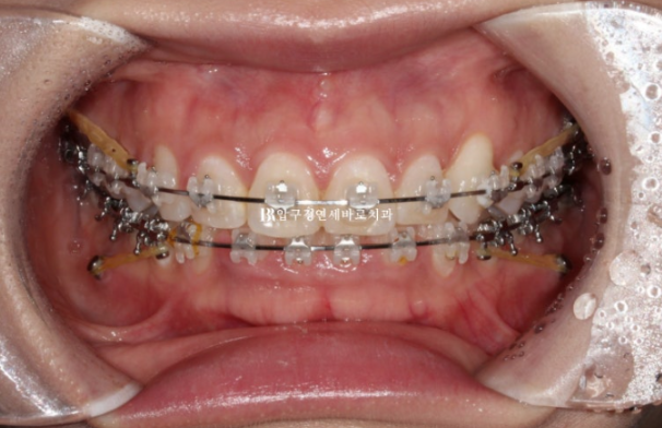 웃을 때 잇몸이 보여요. 잇몸미소 거미스마일 교정하기 관련 이미지 4