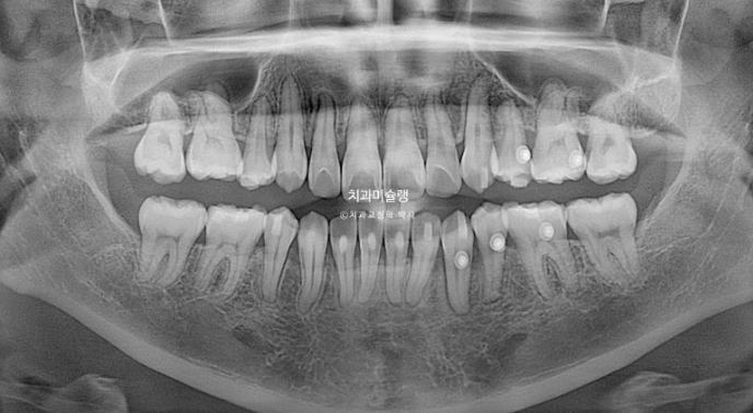 30대 인비절라인 덧니 발치교정 개방교합 치료 관련 이미지 15