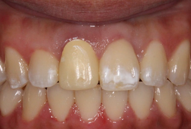 치아 흰색 얼룩 ? 갈아내지 않고 치료하는 법 관련 이미지 1