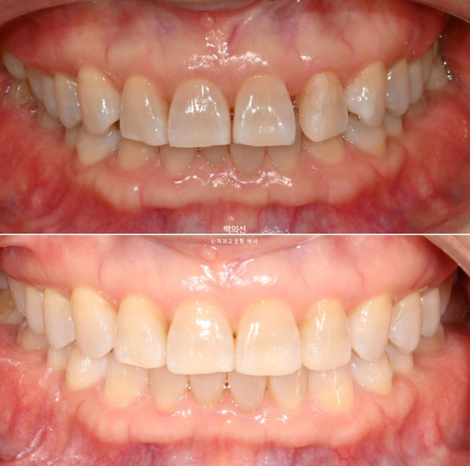 50대 치아교정 :: 인비절라인 익스프레스 치아 벌어짐 단기교정 후기 관련 이미지 15