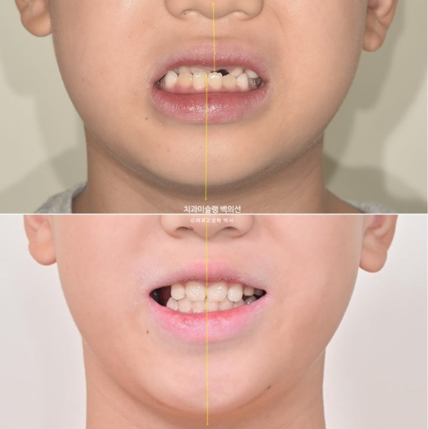 어린이 비대칭 반대교합 주걱턱 인비절라인 퍼스트 프리올소 성장 교정 관련 이미지 27