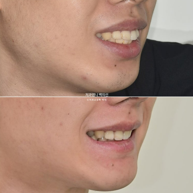 돌출입 발치 교정 인비절라인 후기 미니스크류 관련 이미지 22