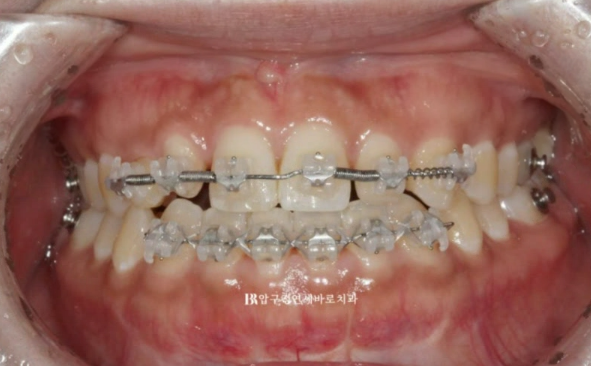 왜소치 치료 잔존유치 무삭제 라미네이트 후기 관련 이미지 6