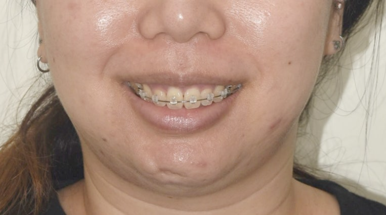 Extraction Orthodontics with Clippy-C for Protruding Mouth, Gum Smile, Gummy Smile Correction, and Treatment for a Recessed Chin image 7