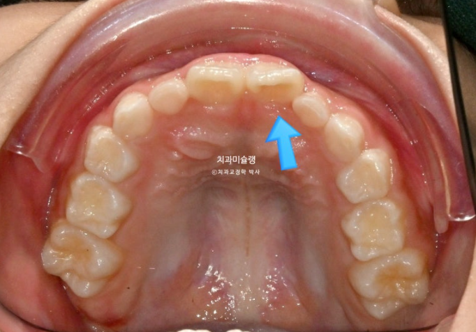 7세 어린이 반대교합 부정교합 프리올소 치료 관련 이미지 8