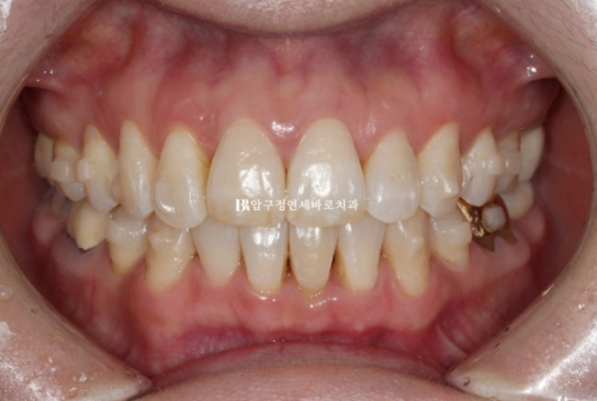 50대 중년교정 인비절라인 라이트 나비치아 교정 앞니 교정 후기 관련 이미지 6