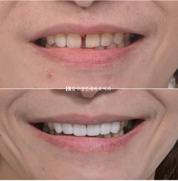 Can Gaps Between the Front Teeth Be Treated with No-Prep Veneers Alone? A Real Case Completed with Gelami After Invisalign Lite image 1