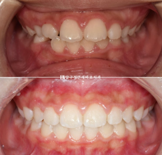 강남 소아교정 인비절라인 퍼스트 어린이 반대교합 관련 이미지 1
