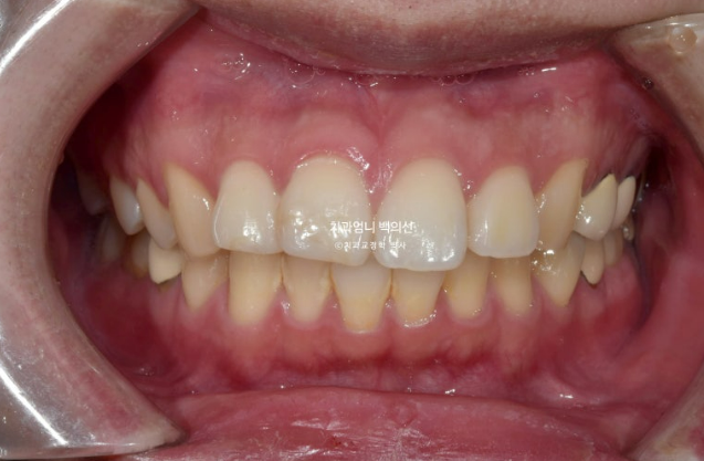 돌출입 발치 교정 인비절라인 후기 미니스크류 관련 이미지 2