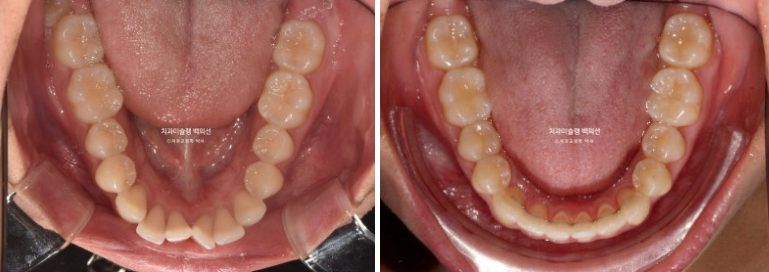 비발치 인비절라인 교정 돌출입 교정 후기 관련 이미지 17