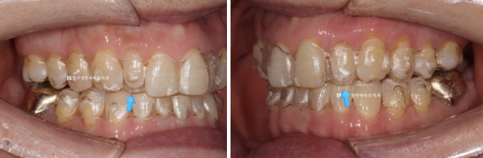 50s Invisalign Lite No-Prep Laminate Bunny Teeth image 6