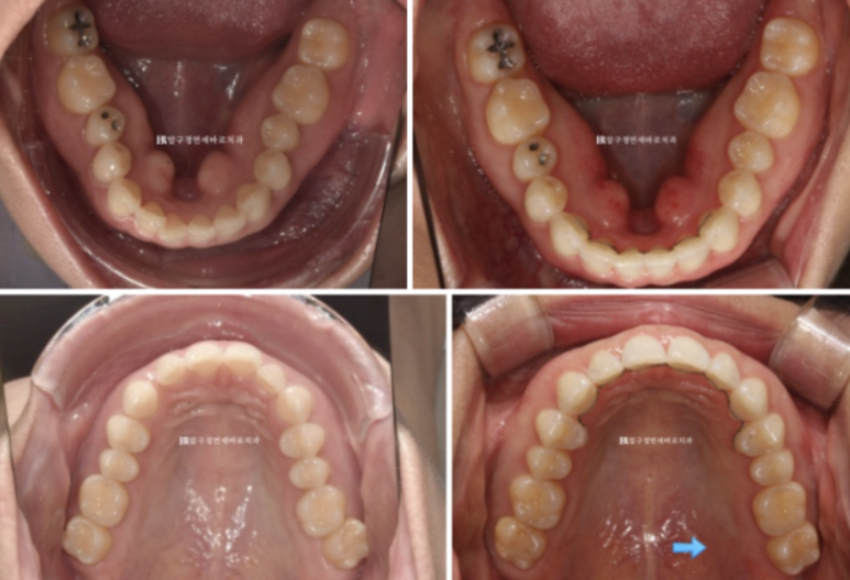 인비절라인 라이트 가위교합 치아 벌어짐 치료 관련 이미지 11