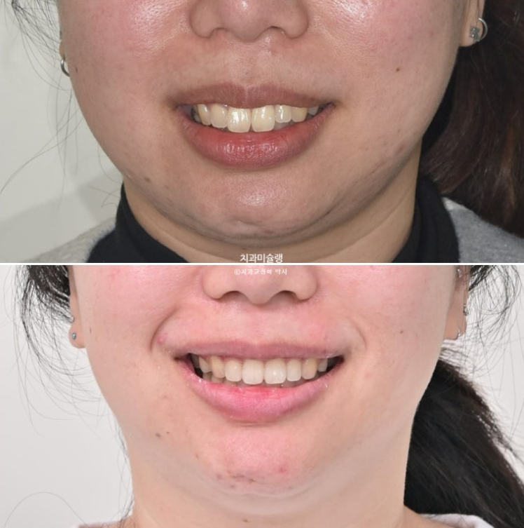 Extraction Orthodontics with Clippy-C for Protruding Mouth, Gum Smile, Gummy Smile Correction, and Treatment for a Recessed Chin image 19