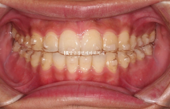 인비절라인 라이트 교정 덧니 이소맹출 반대교합 관련 이미지 8