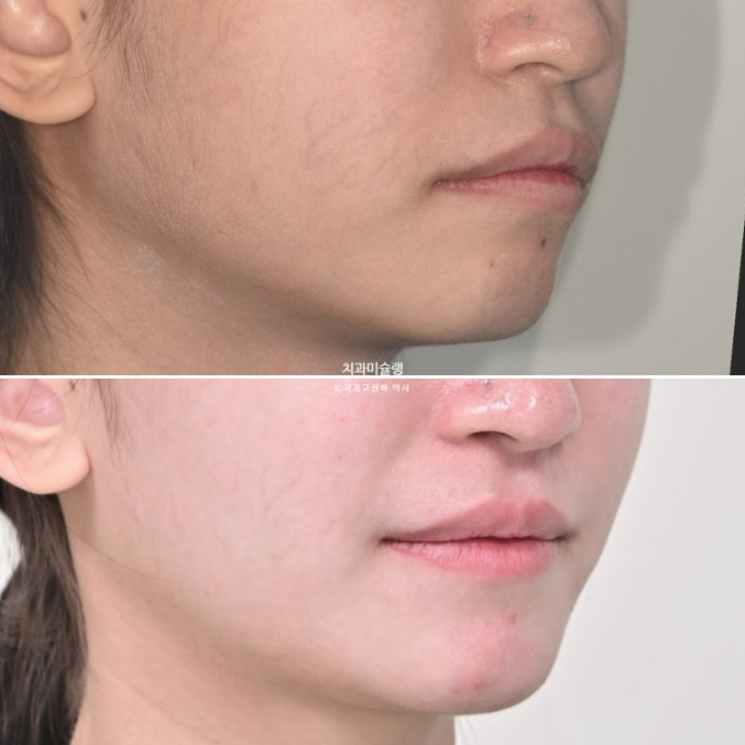 잇몸미소 거미스마일 치료 옥니 교정 잇몸성형 후기 관련 이미지 20