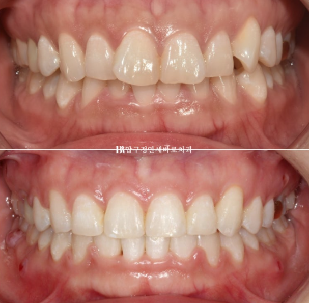 웃을 때 잇몸이 보여요. 잇몸미소 거미스마일 교정하기 관련 이미지 10