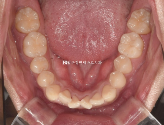 인비절라인 라이트 교정 덧니 이소맹출 반대교합 관련 이미지 5