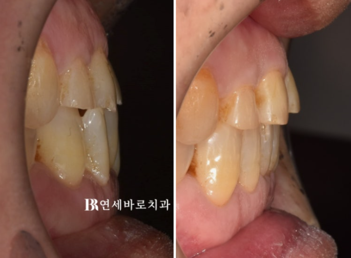 무삭제 라미네이트 하러 왔다가 부분교정을 먼저 한 이유 관련 이미지 4