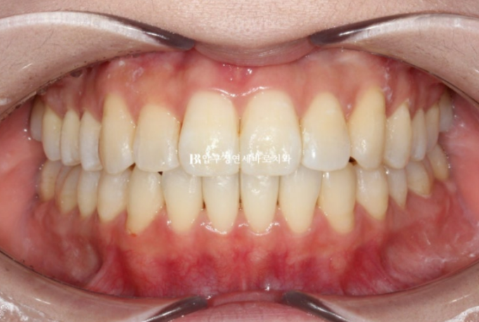 Invisalign Lite Treatment for Crossbite, Rabbit Teeth, and Protruding Front Teeth Correction image 7