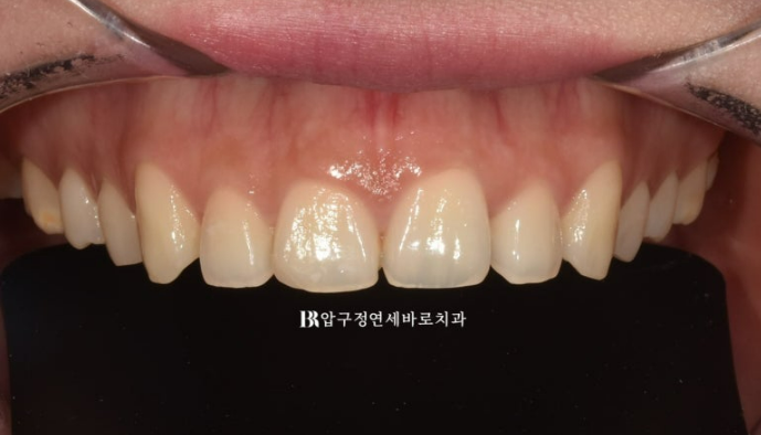 스마일라인 개선 무삭제 라미네이트 실제 두께 ? 관련 이미지 3