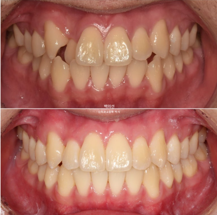 유학생 교정 덧니 반대교합 인비절라인 라이트 치료기간 관련 이미지 15