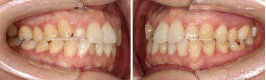 토끼이빨 치아교정 ? 토끼이빨 교정 치료기간은 어떻게 되나요? 관련 이미지 3