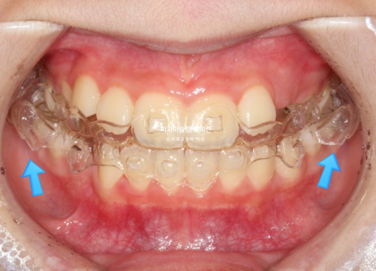 어린이 무턱 성장교정 덧니 인비절라인 퍼스트 악궁확장 치료기간 2년 관련 이미지 14