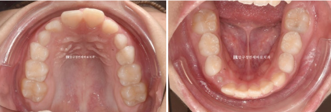 A Child’s Protruding Teeth Correction Review: Difficulty Closing the Lips image 5