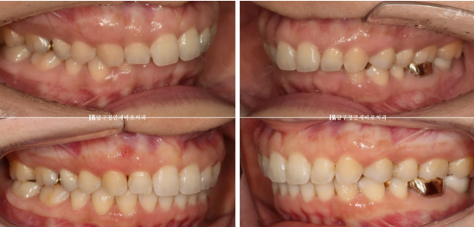 인비절라인 캔팅 교정 과개교합 교정 임플란트 재교정 관련 이미지 13