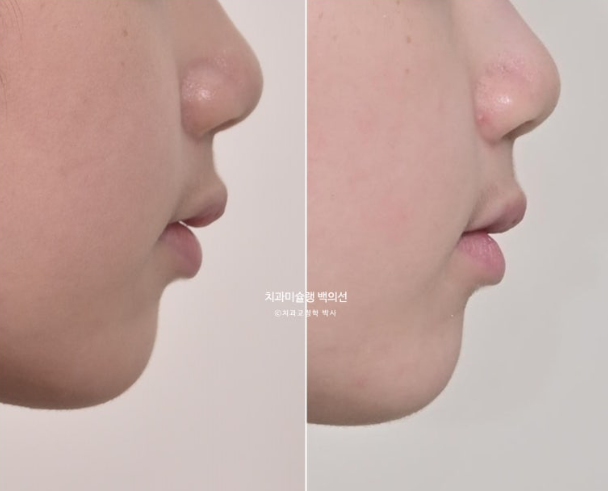 과개교합 인비절라인 모더레이트 컴프레헨시브 중심선 토끼이빨 관련 이미지 18