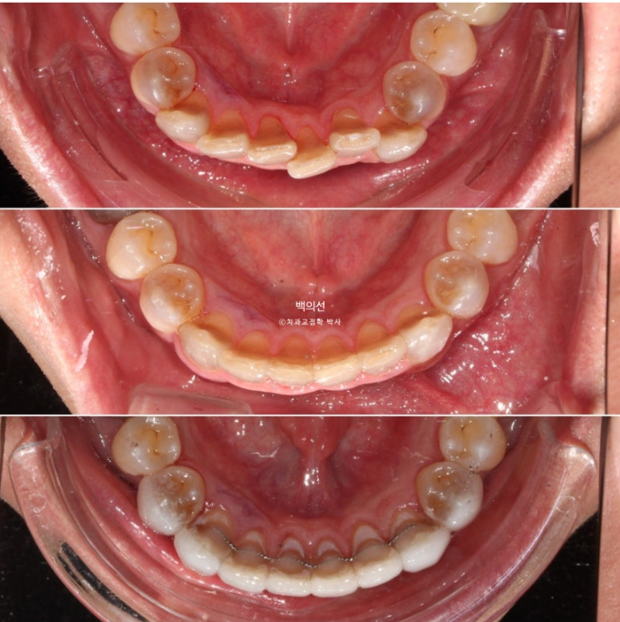 Treatment Review: No-Prep Laminate for Tetracycline-Stained Teeth image 19