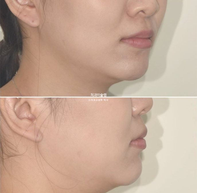 30대 인비절라인 덧니 발치교정 개방교합 치료 관련 이미지 7