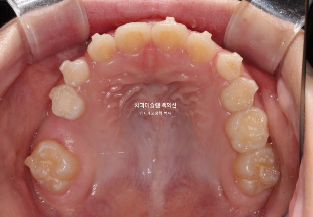 어린이 비대칭 반대교합 주걱턱 인비절라인 퍼스트 프리올소 성장 교정 관련 이미지 14