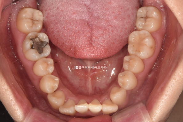 Is compliance important for Invisalign? | A real case that improved reverse bite and scissors bite in 8 months image 5