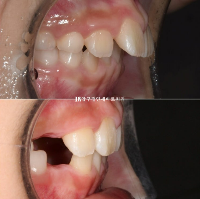 무턱교정 어린이 투명교정 인비절라인 퍼스트 교정 후기 관련 이미지 23