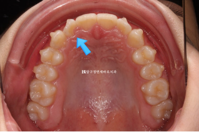 인비절라인라이트 덧니 과개교합 교정 치료기간 9개월 관련 이미지 5