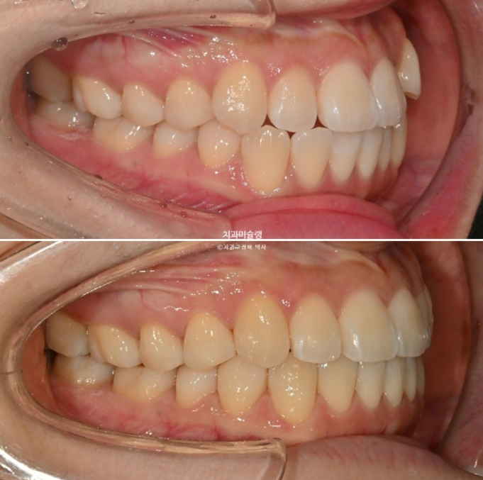 인비절라인 라이트 반대교합? 덧니 중심선 치간삭제 치료 관련 이미지 16