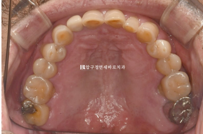 50대 중년교정 무삭제 라미네이트 중년 부분교정 후기 관련 이미지 3