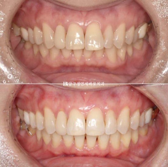 40대 인비절라인 라이트 가위교합? 관련 이미지 17