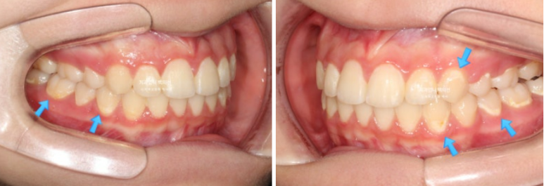 입이 안 다물어짐 입술부전증 호두턱 교정? 관련 이미지 11