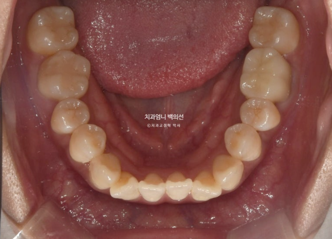 비발치 교정 덧니 인비절라인 교정 절단교합 반대교합 치료기간 1년 6개월 관련 이미지 8